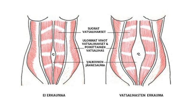 Erkaumassa suorien vatsalihasten välissä oleva valkoinen jännesauma on venynyt.